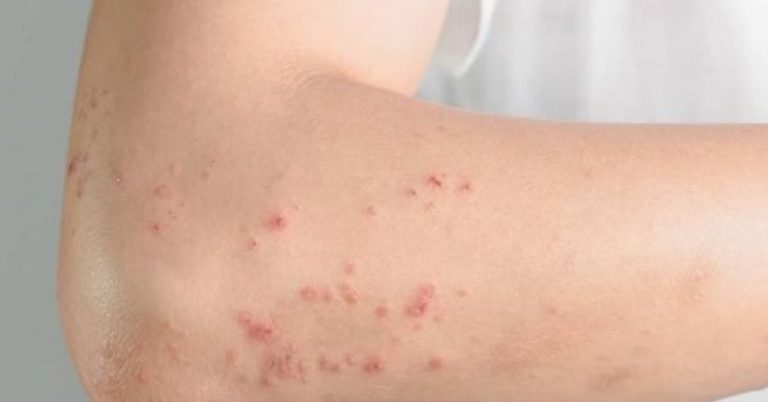 Quase um quarto das crianças e 7% dos adultos no Brasil sofrem de dermatite atópica